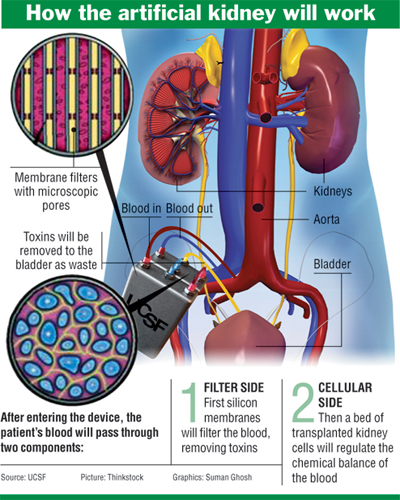 artificial kidney transplant