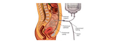 peritoneal-dialysis